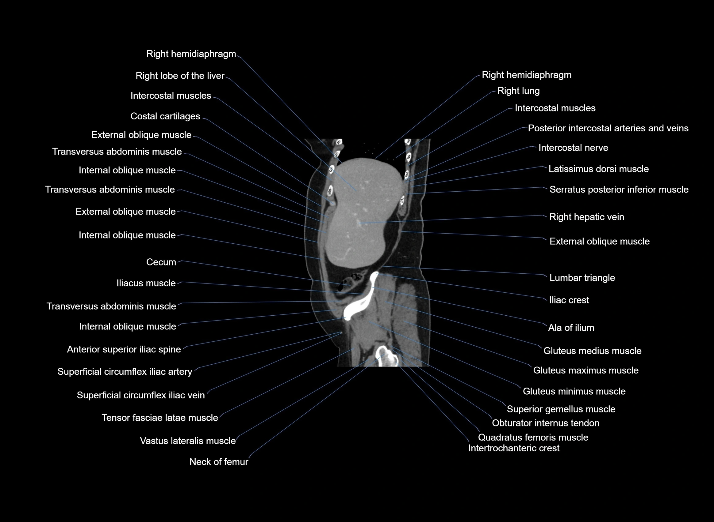 CT Abdomen sagittal cross sectional anatomy labelled radiology image -00094.webp